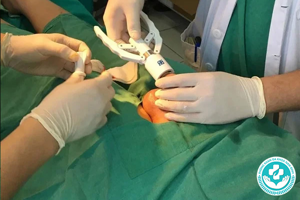 Cắt bao quy đầu để làm gì?