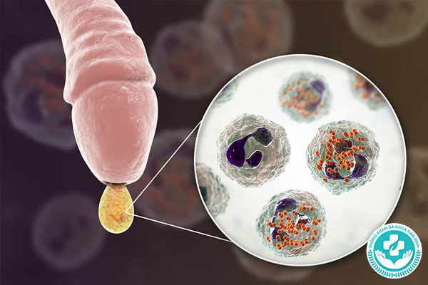 Viêm bao quy đầu do nhiễm trùng