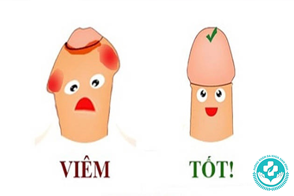 Viêm bao quy đầu do dị ứng