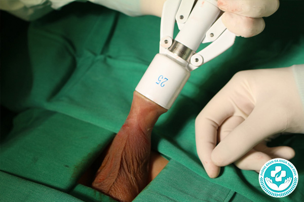 Cắt bao quy đầu Nam Định