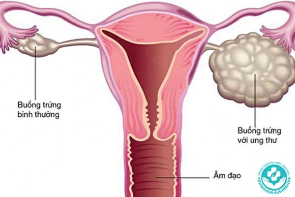 Bệnh ung thư buồng trứng