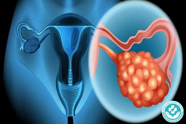 Bệnh ung thư buồng trứng có nguy hiểm không?