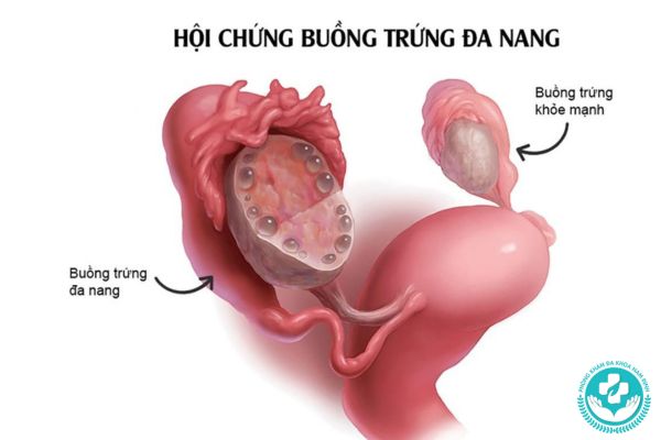 Bệnh buồng trứng đa nang