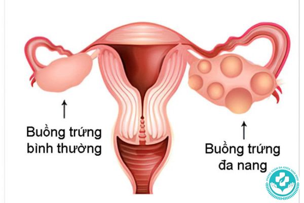 Bệnh buồng trứng đa nang có nguy hiểm không?