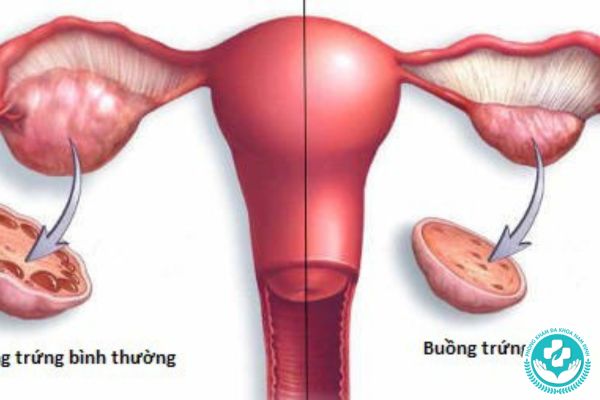 Bệnh suy buồng trứng