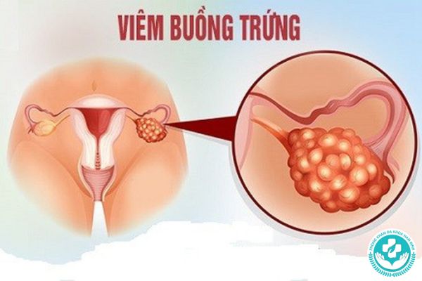 Bệnh viêm buồng trứng