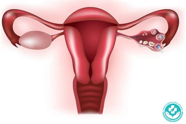 Bệnh viêm buồng trứng có nguy hiểm không?