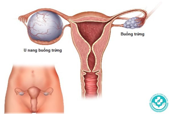 Bệnh u nang buồng trứng