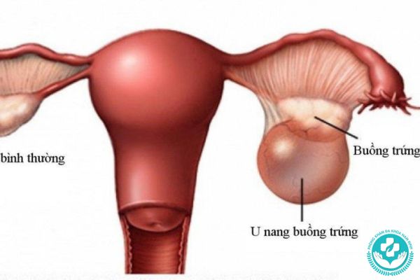 Bệnh u nang buồng trứng có nguy hiểm không?