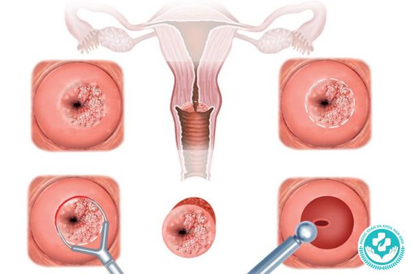 Lộ tuyến cổ tử cung