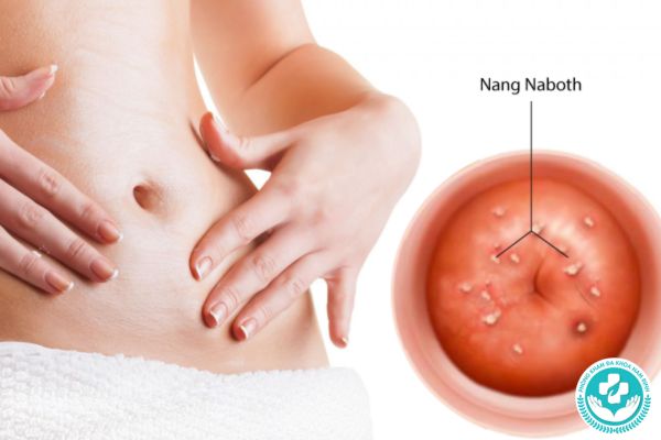 Nang naboth cổ tử cung
