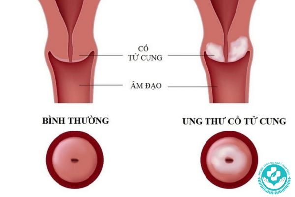 Ung thư cổ tử cung