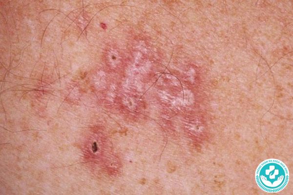 Bệnh lậu là gì?