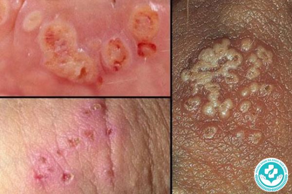 Biển hiện của bệnh lậu ở mọi giới tính