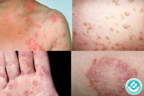 Bệnh lậu có nguy hiểm không?