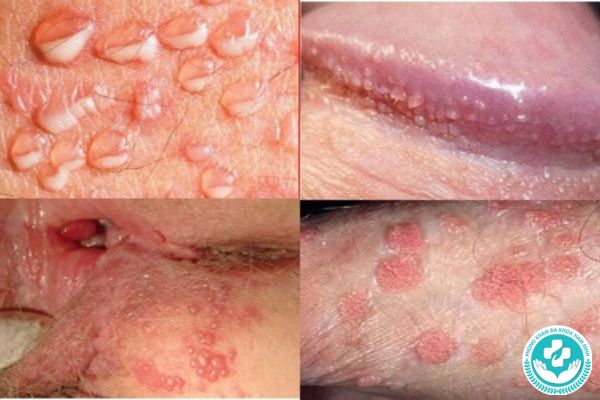 Bệnh tình dục là gì?