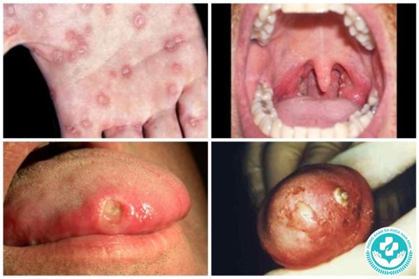 Khi mắc bệnh tình dục thì sẽ có biểu hiện gì?