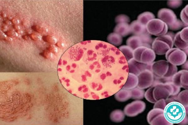 Nguyên nhân gây ra bệnh tình dục