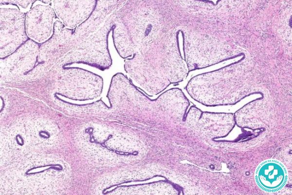 Bệnh u diệp thể tuyến vú