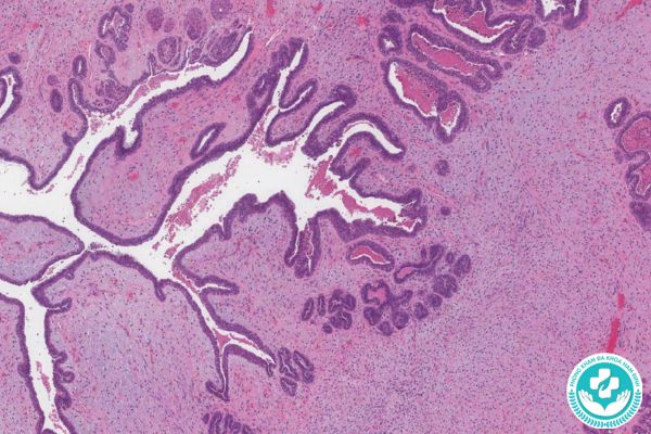 Bệnh u diệp thể tuyến vú có nguy hiểm không?