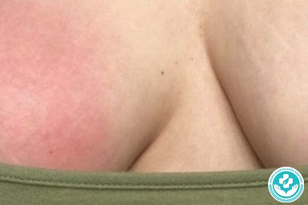 Bệnh viêm tuyến vú