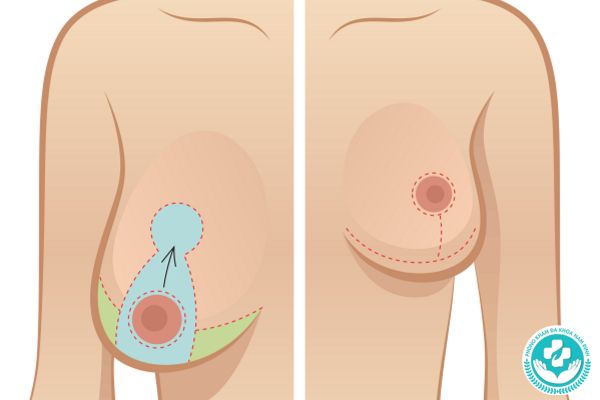 Bệnh phì đại tuyến vú