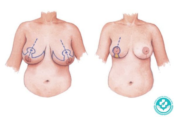 Bệnh phì đại tuyến vú có nguy hiểm không?