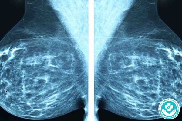 Bệnh vôi hóa vú