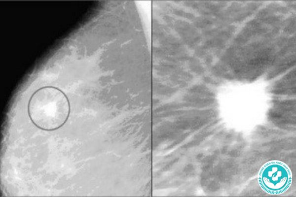 Bệnh vôi hóa vú có nguy hiểm không?