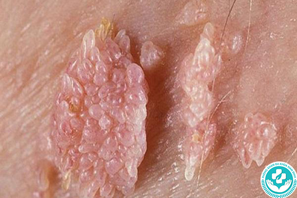 Bệnh sùi mào gà