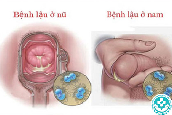 Bệnh lậu