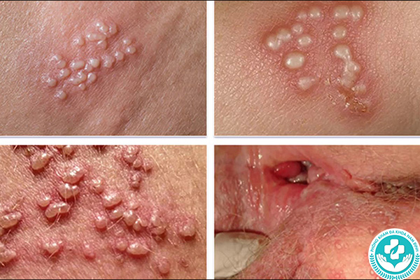 Bệnh mụn rộp sinh dục