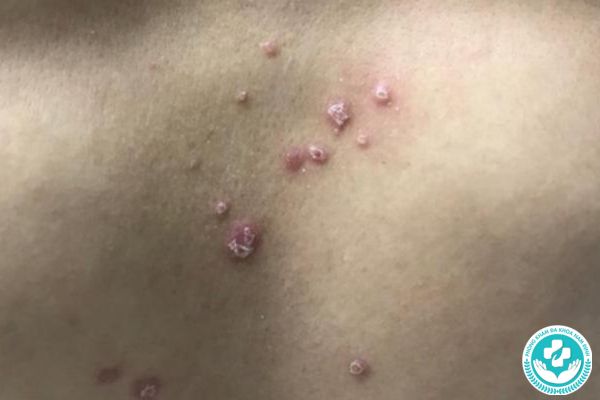 Biểu hiện của bệnh giang mai thời kỳ đầu