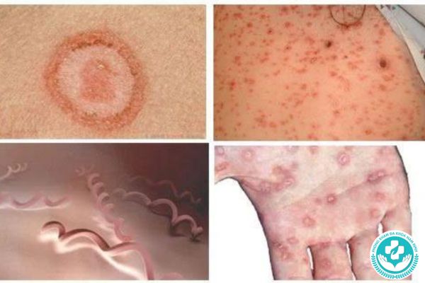 Biểu hiện của bệnh giang mai thời kỳ cuối