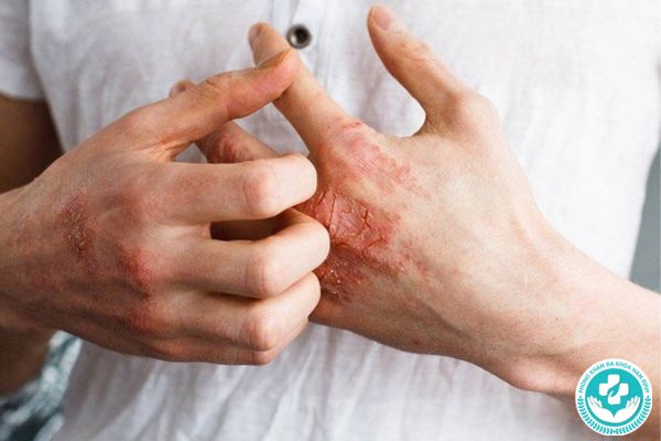 Giang mai sẽ ủ bệnh trong bao lâu?