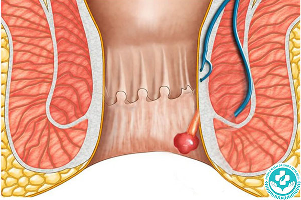 Nguyên nhân gây polyp hậu môn