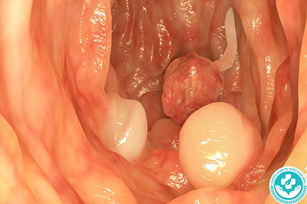 Biến chứng của polyp hậu môn