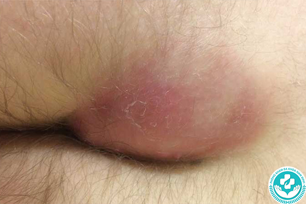 Nguyên nhân gây sưng hậu môn