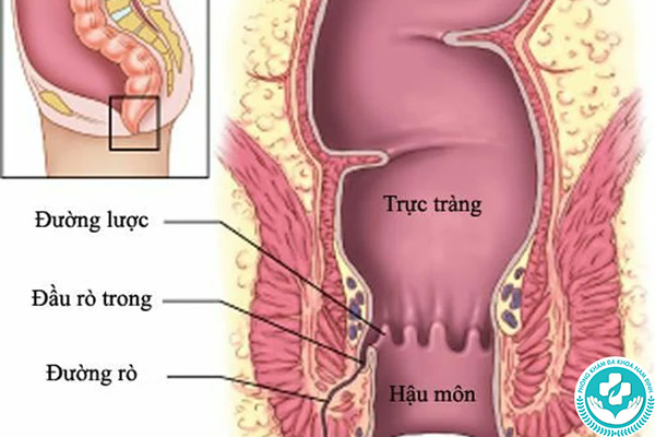 Nguyên nhân gây rò hậu môn