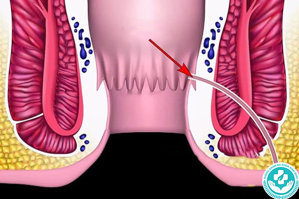 Biến chứng của rò hậu môn