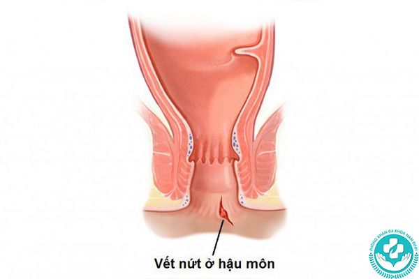 Nguyên nhân gây nứt kẽ hậu môn