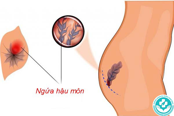 Nguyên nhân gây ngứa hậu môn