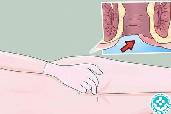 Nguyên nhân gây bệnh trĩ