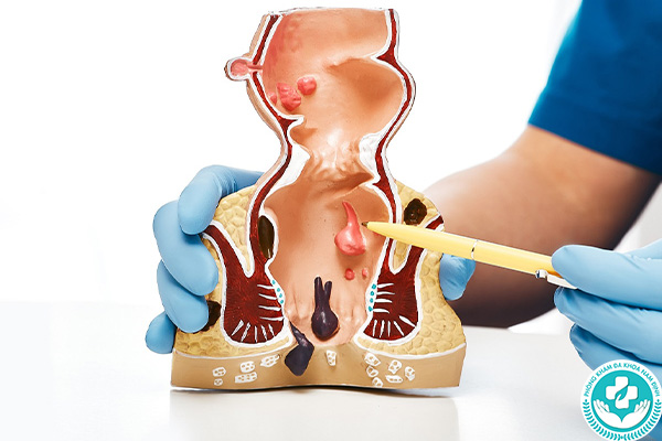 Bệnh hậu môn trực tràng là gì?