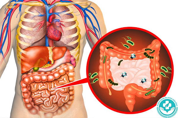 Tại sao lại bị bệnh hậu môn trực tràng?