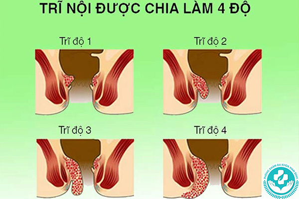 Biến chứng của bệnh trĩ