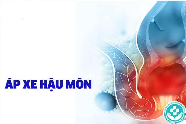 Nguyên nhân gây áp xe hậu môn