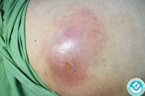 Biến chứng của áp xe hậu môn