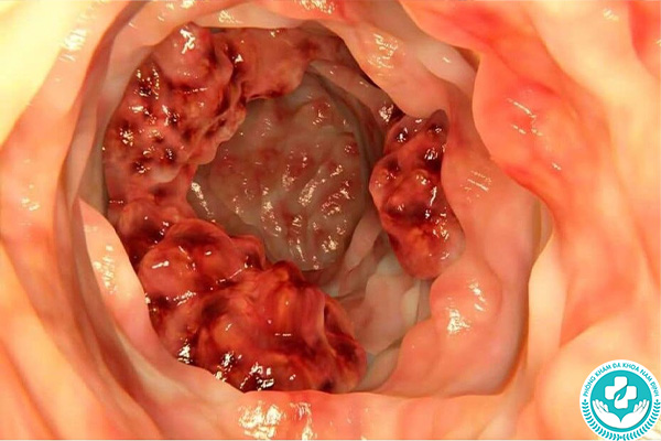 Biến chứng của ung thư hậu môn