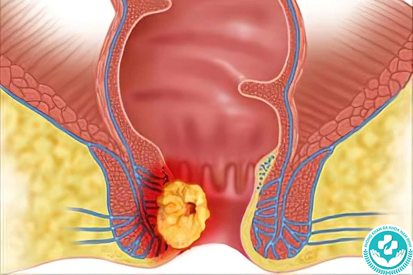 Nguyên nhân gây ung thư hậu môn